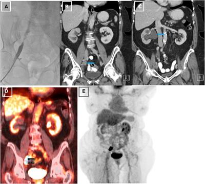 Case report: Non-thrombotic iliac vein lesion: an unusual cause of unilateral leg swelling in a patient with endometrial carcinoma